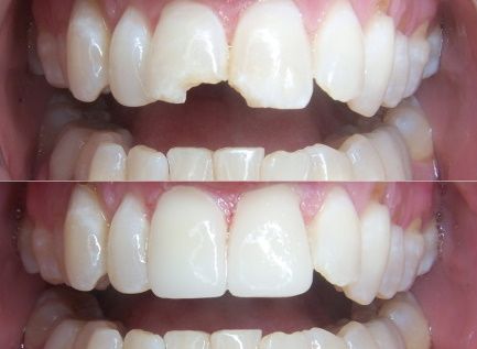 Dental Care Marbella antes y despues dentadura