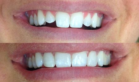 Dental Care Marbella boca con dientes blancos